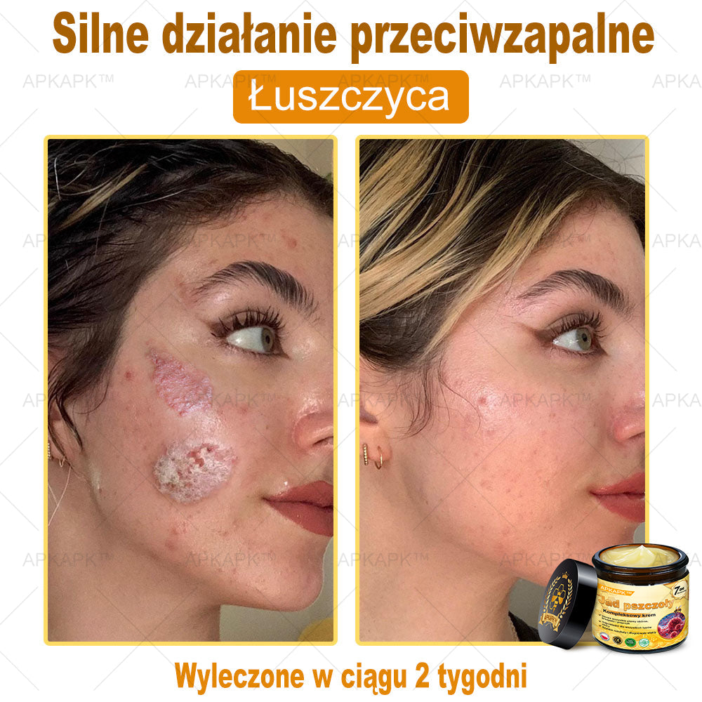 ΑPΚΑPK™ Jad Pszczoły Kompleksowy Krem🥇pomaga w leczeniu problemów skórnych, takich jak: zmarszczki, blizny, plamy pigmentacyjne, rozstępy, trądzik, łuszczyca, egzema, zmiany skórne, podrażnienia, stany zapalne i inne problemy skórne🔥
